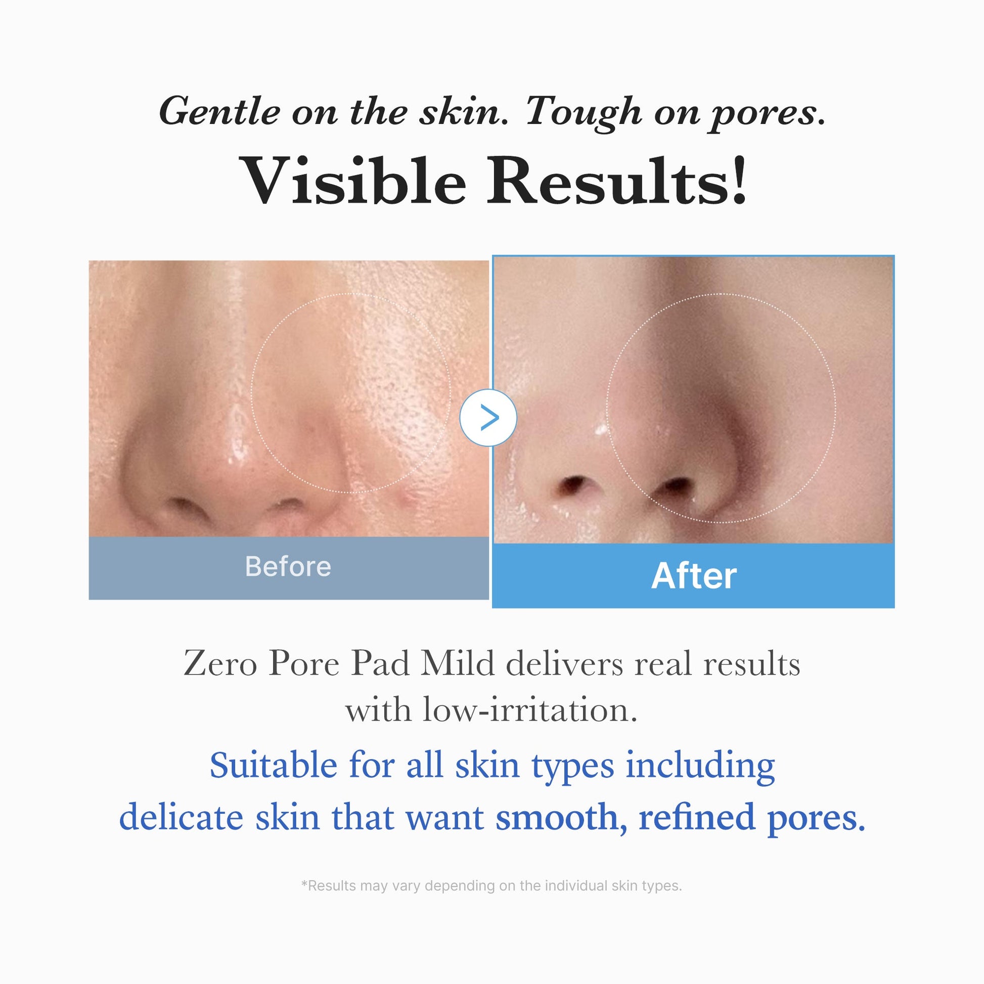 zero-pore-madecassoside-pads-mild-q0 04_6357f9f9-483b-4891-82c6-a58d336e62c8.jpg